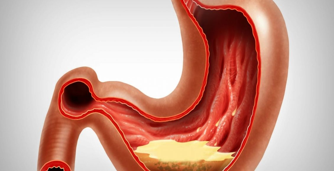 Como aliviar os sintomas da azia durante as festas de final de ano? Fonte: Pixabay