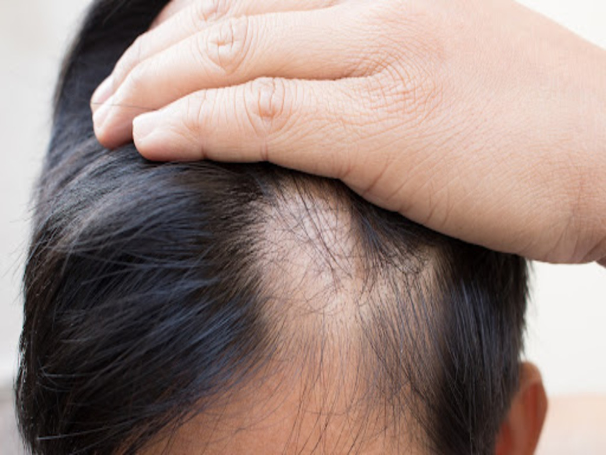 O que é alopecia, quais os tipos e tratamentos para a condição? - Fonte: Pixabay