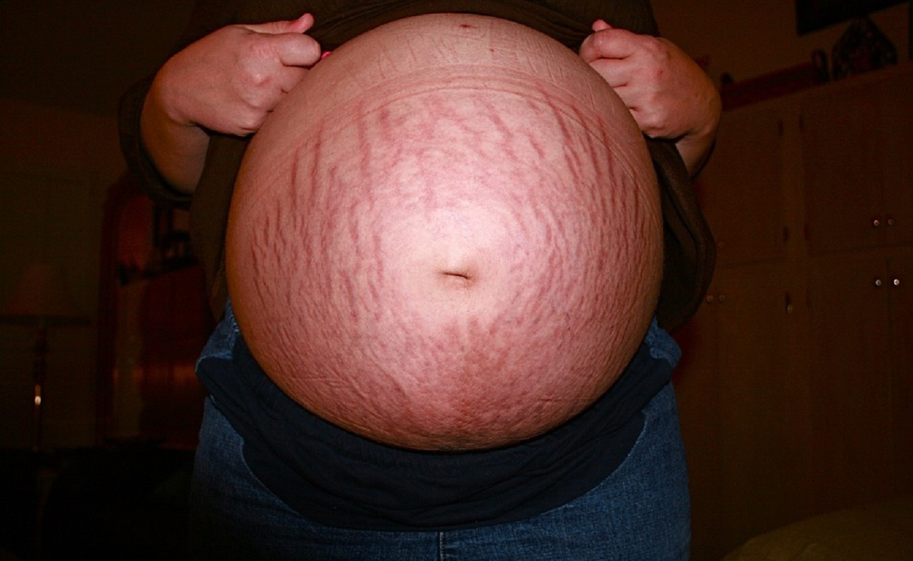 Estrias: Mitos e verdades sobre as marcas que aparecem na pele - Reprodução: Pixabay