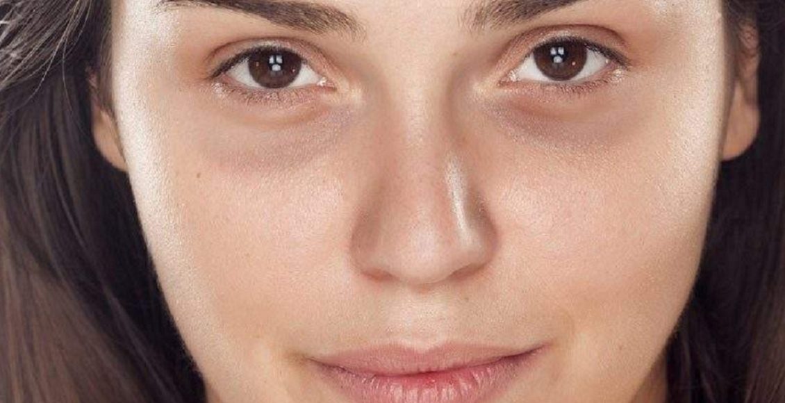 Tratar as olheiras (Foto: Reprodução/Pexels)