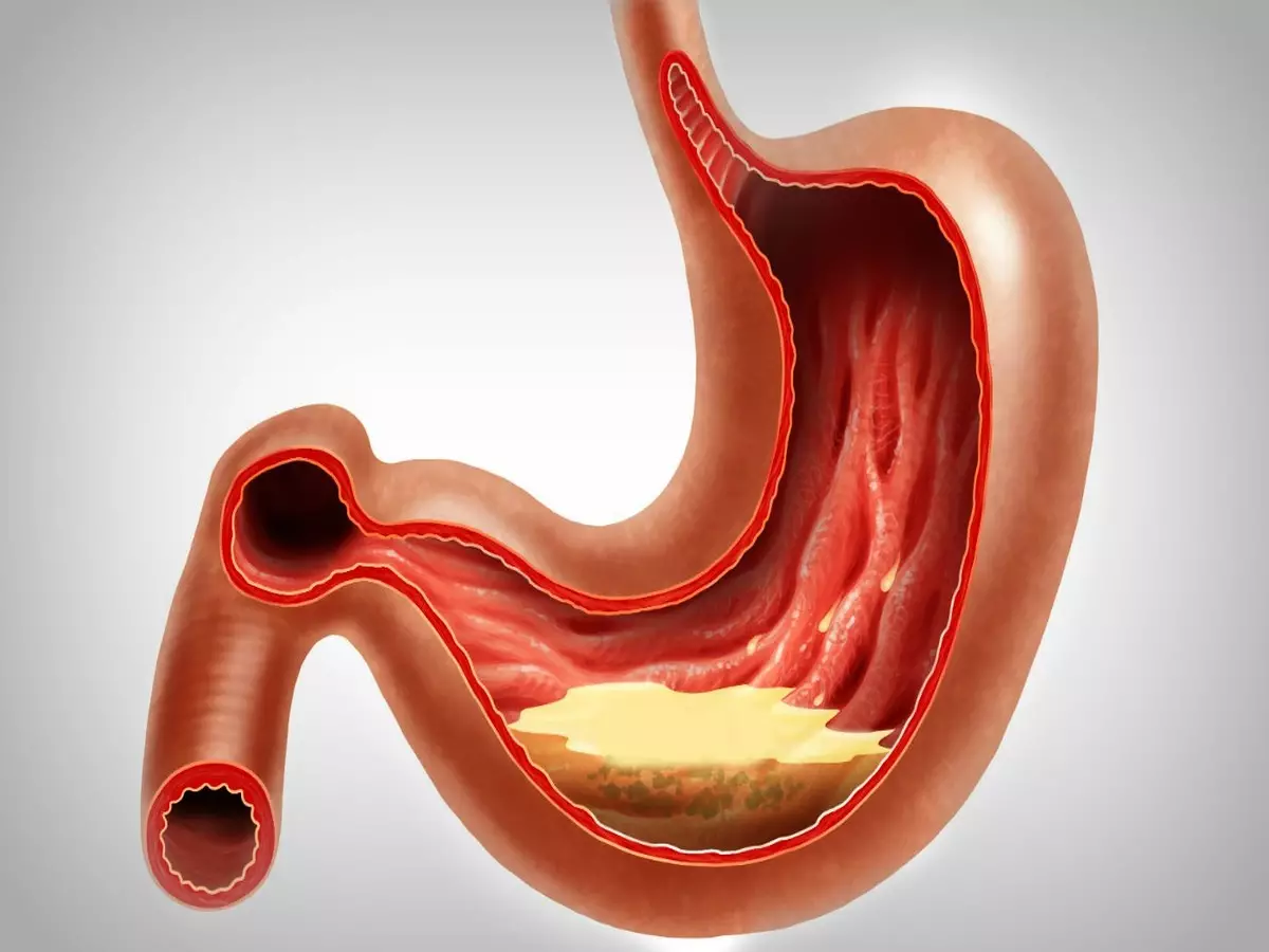 Gastrite muito forte? Saiba como diminuir sensação de queimação Fonte Canvas