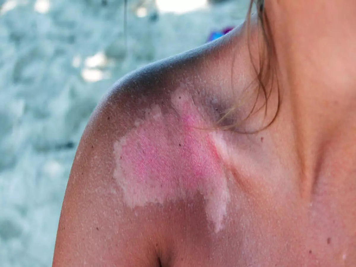 Queimadura de sol: veja dicas simples para tratar em casa em poucos passos - Fonte: Canva