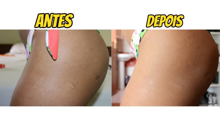 (Clarear partes íntimas/Ilustração)