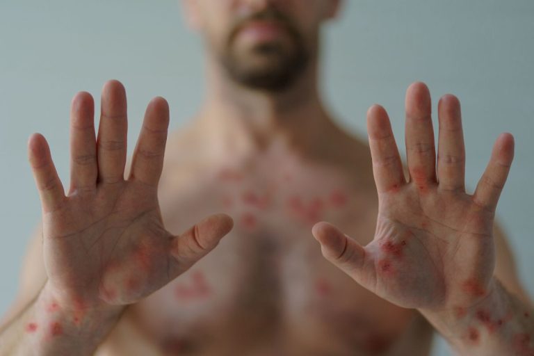 Varíola dos macacos tem alta na quantidade de casos confirmados