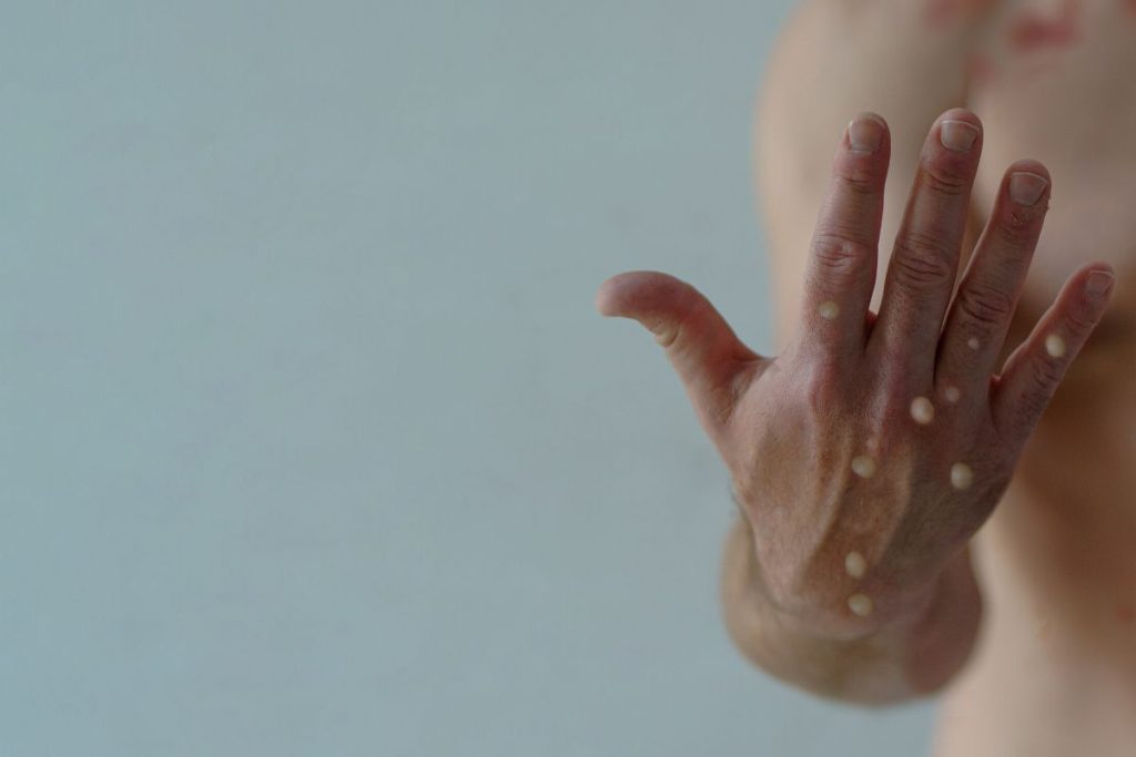 Devido a varíola dos macacos a OMS decide declarar emergência global