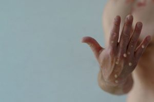 Devido a varíola dos macacos a OMS decide declarar emergência global