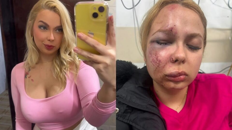 Larissa, 24 anos, perdeu dentes e sofreu fraturas após ataque no metrô. Imagem: arquivo pessoal