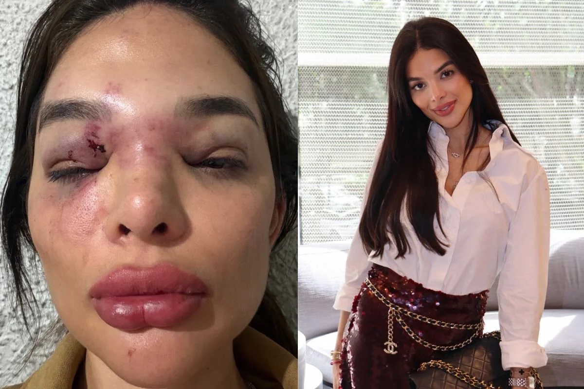Giullia foi agredida na semana do casamento com Ivo Kos. Imagem: Redes sociais